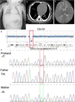 Congenital Myasthenic Syndrome Caused by a Novel Hemizygous CHAT Mutation